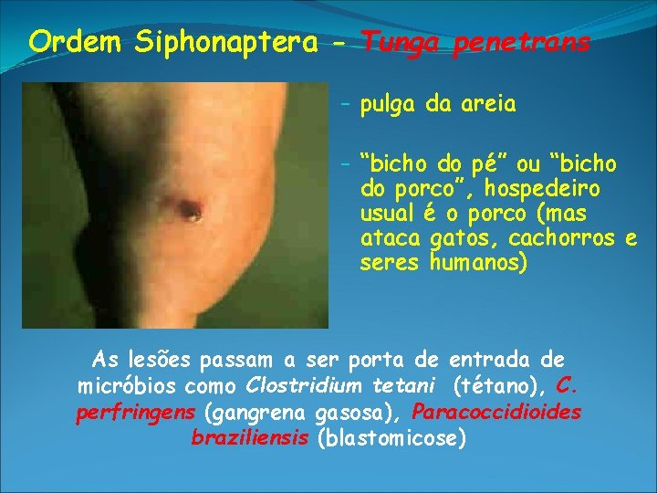 Ordem Siphonaptera - Tunga penetrans – pulga da areia – “bicho do pé” ou