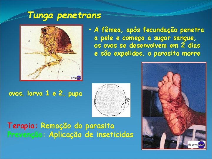 Tunga penetrans • A fêmea, após fecundação penetra a pele e começa a sugar