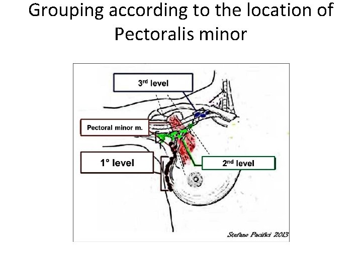 Grouping according to the location of Pectoralis minor 