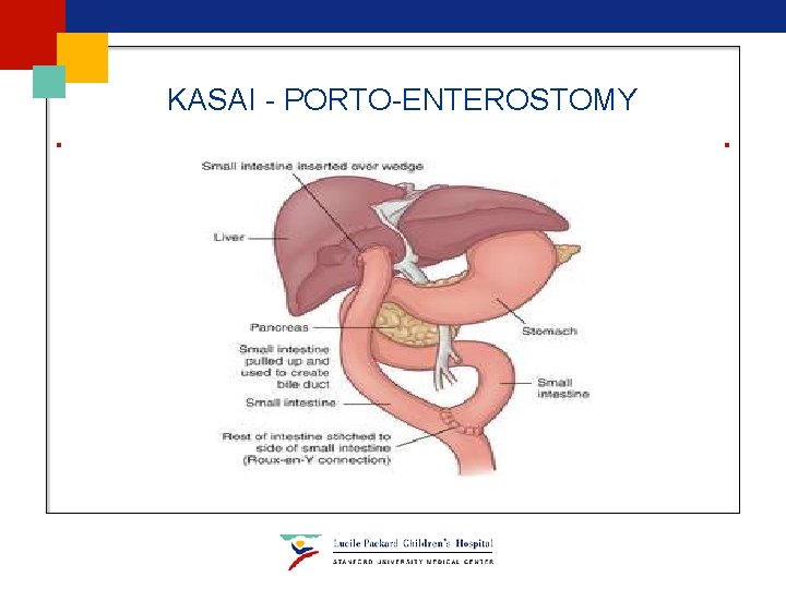 KASAI - PORTO-ENTEROSTOMY KASAI - PORTO-ENTEROSTOMY