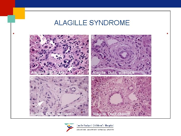 ALAGILLE SYNDROME ALAGILLE SYNDROME