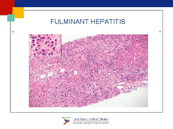 FULMINANT HEPATITIS FULMINANT HEPATITIS