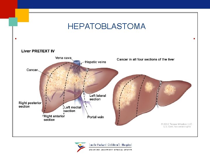 HEPATOBLASTOMA HEPATOBLASTOMA
