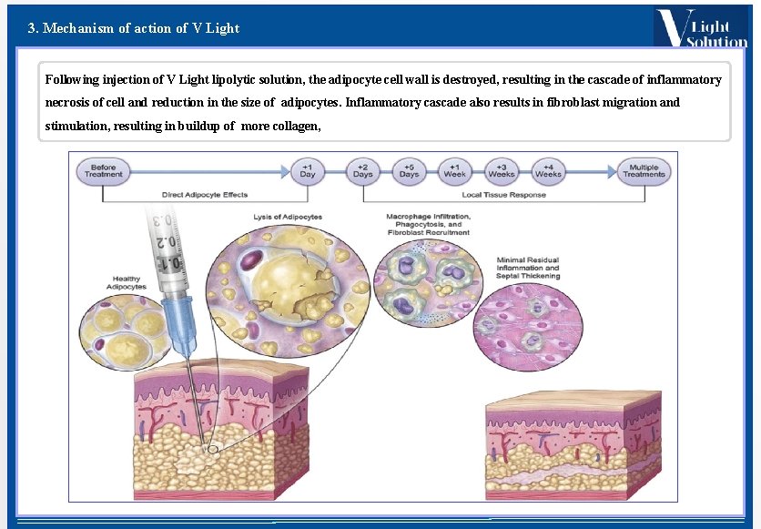 3. Mechanism of action of V Light Following injection of V Light lipolytic solution,