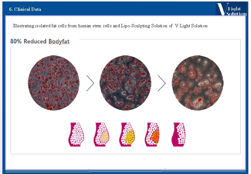 6. Clinical Data Illustrating isolated fat cells from human stem cells and Lipo-Sculpting Solution