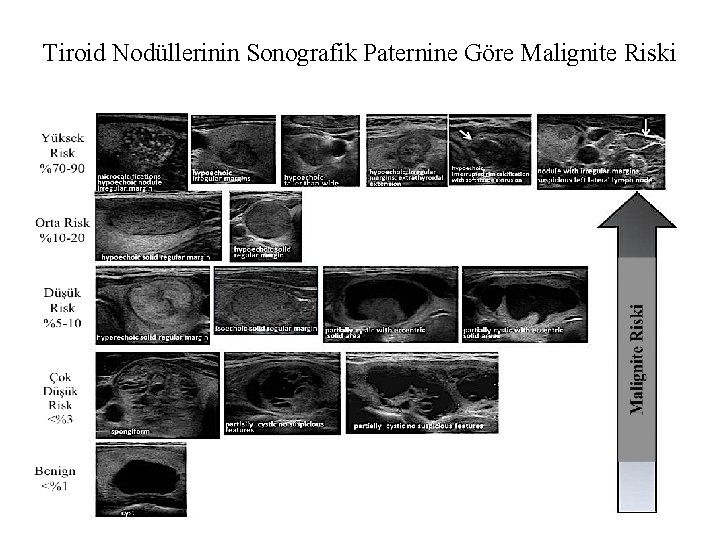 Tiroid Nodüllerinin Sonografik Paternine Göre Malignite Riski 