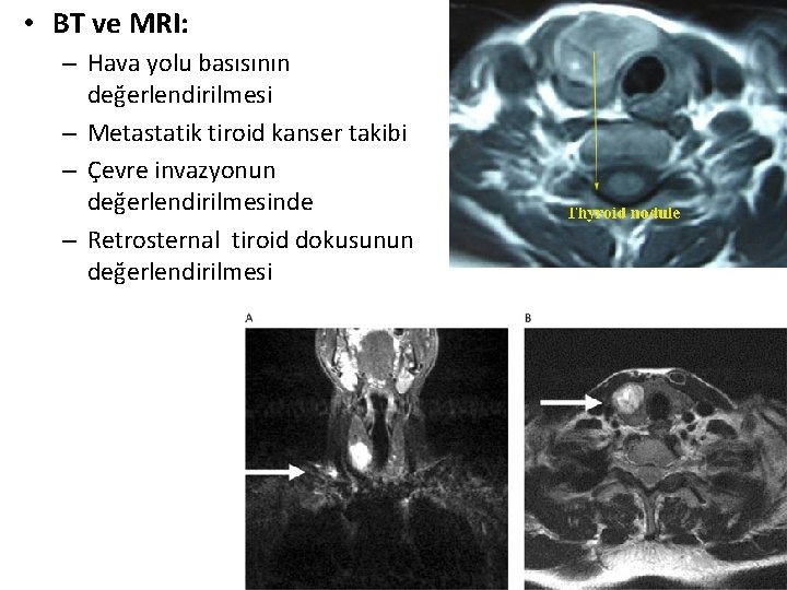  • BT ve MRI: – Hava yolu basısının değerlendirilmesi – Metastatik tiroid kanser