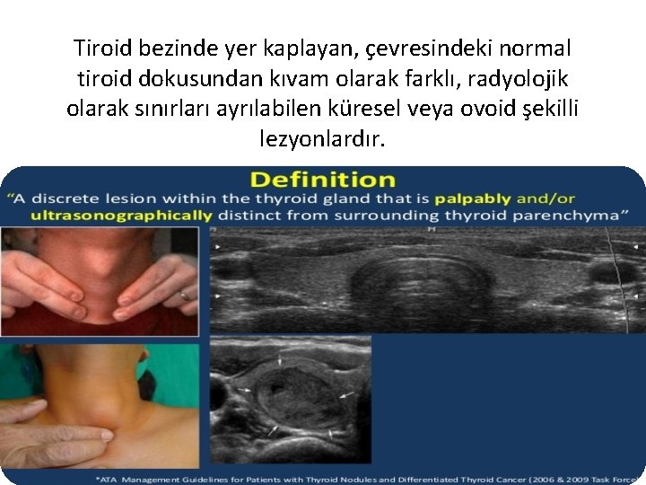 Tiroid bezinde yer kaplayan, çevresindeki normal tiroid dokusundan kıvam olarak farklı, radyolojik olarak sınırları