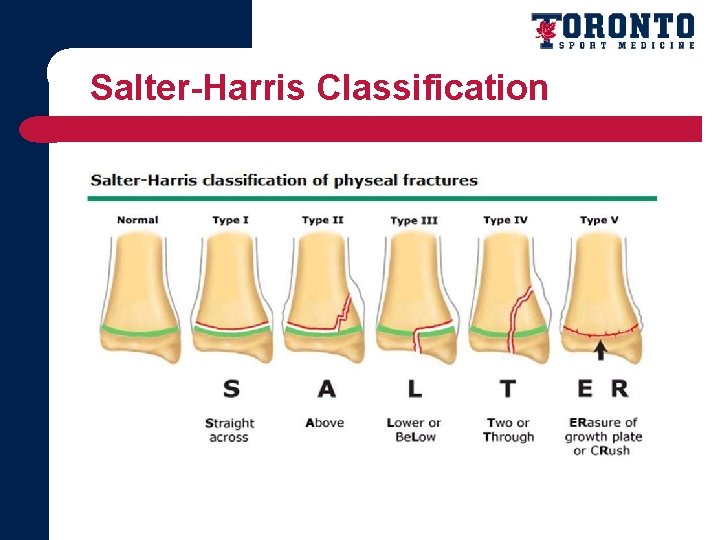 Salter-Harris Classification Buckle fractures 