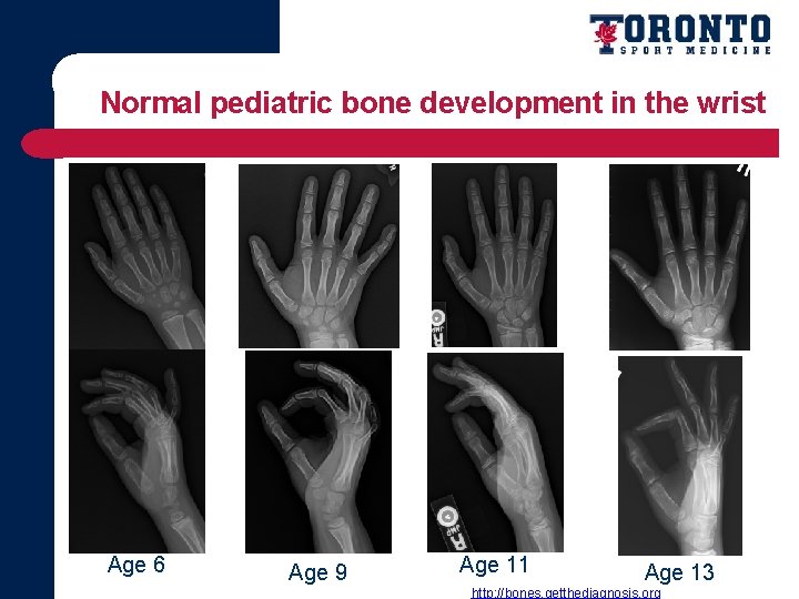 Normal pediatric bone development in the wrist Age 6 Age 9 Age 11 Age