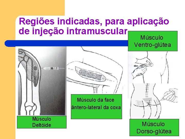 Regiões indicadas, para aplicação de injeção intramuscular Músculo Ventro-glútea Músculo da face ântero-lateral da Regiões indicadas, para aplicação de injeção intramuscular Músculo Ventro-glútea Músculo da face ântero-lateral da