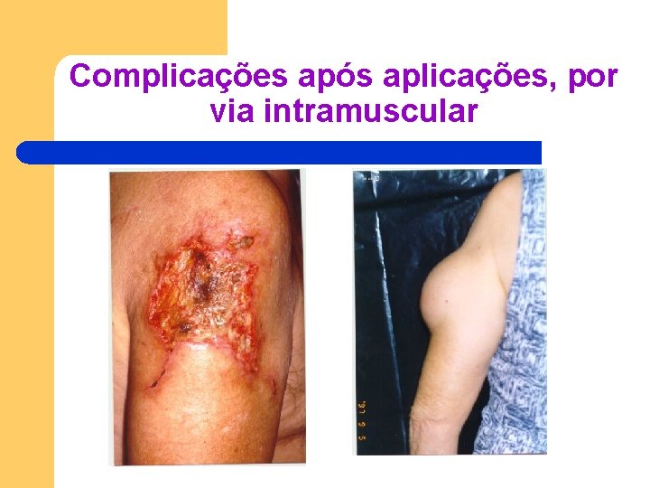 Complicações após aplicações, por via intramuscular Complicações após aplicações, por via intramuscular