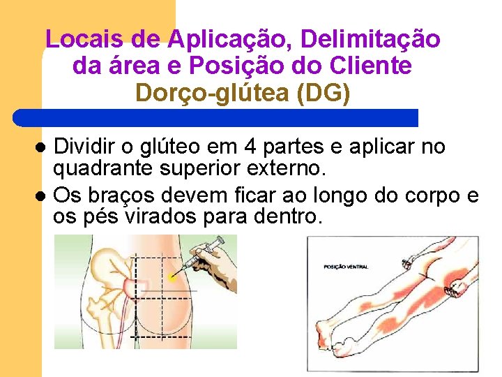 Locais de Aplicação, Delimitação da área e Posição do Cliente Dorço-glútea (DG) Dividir o Locais de Aplicação, Delimitação da área e Posição do Cliente Dorço-glútea (DG) Dividir o