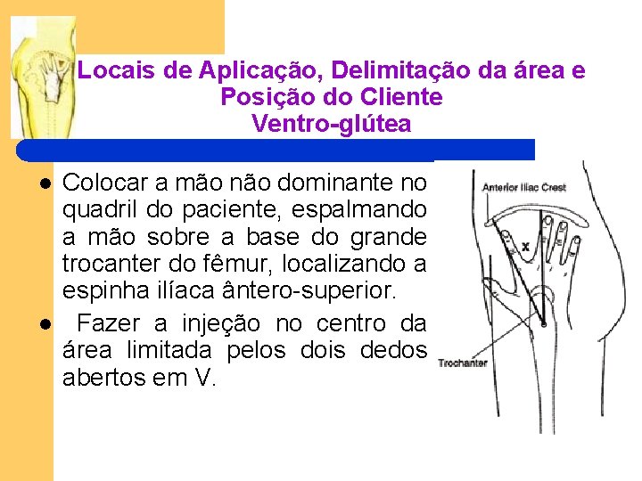 Locais de Aplicação, Delimitação da área e Posição do Cliente Ventro-glútea l l Colocar Locais de Aplicação, Delimitação da área e Posição do Cliente Ventro-glútea l l Colocar
