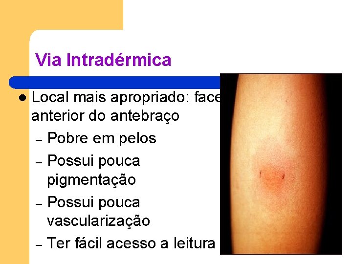 Via Intradérmica l Local mais apropriado: face anterior do antebraço – Pobre em pelos Via Intradérmica l Local mais apropriado: face anterior do antebraço – Pobre em pelos
