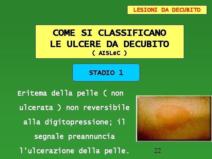 LESIONI DA DECUBITO COME SI CLASSIFICANO LE ULCERE DA DECUBITO ( AISLe. C )