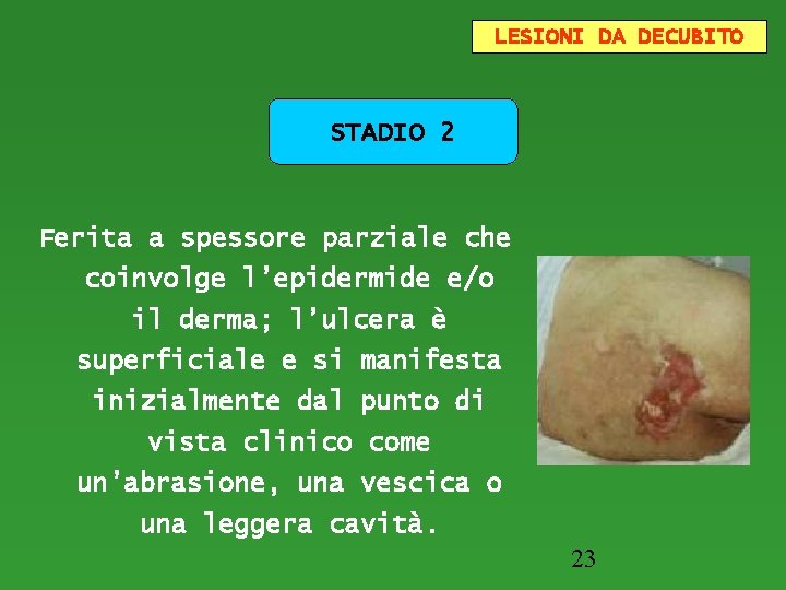 LESIONI DA DECUBITO STADIO 2 Ferita a spessore parziale che coinvolge l’epidermide e/o il