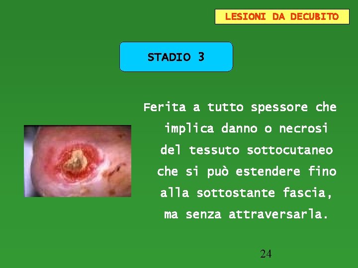 LESIONI DA DECUBITO STADIO 3 Ferita a tutto spessore che implica danno o necrosi