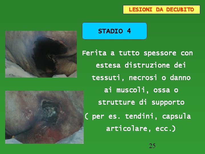 LESIONI DA DECUBITO STADIO 4 Ferita a tutto spessore con estesa distruzione dei tessuti,