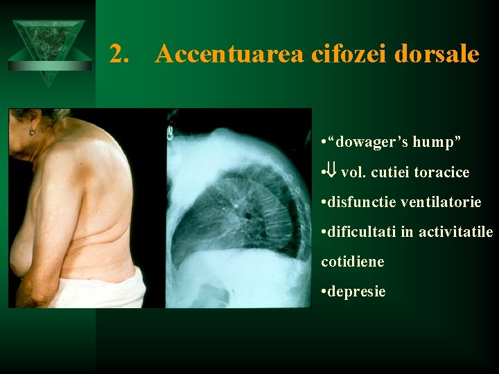2. Accentuarea cifozei dorsale • “dowager’s hump” • vol. cutiei toracice • disfunctie ventilatorie