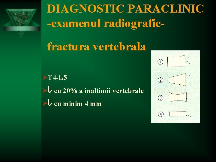 DIAGNOSTIC PARACLINIC -examenul radiograficfractura vertebrala ØT 4 -L 5 Ø cu 20% a inaltimii