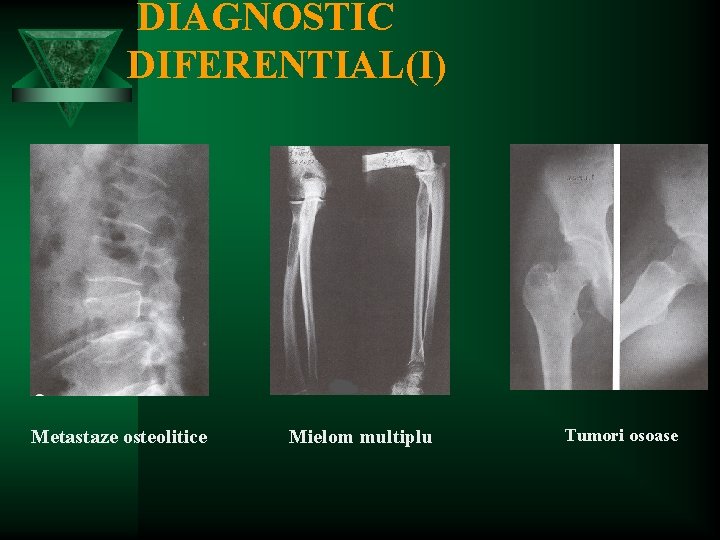 DIAGNOSTIC DIFERENTIAL(I) Metastaze osteolitice Mielom multiplu Tumori osoase 