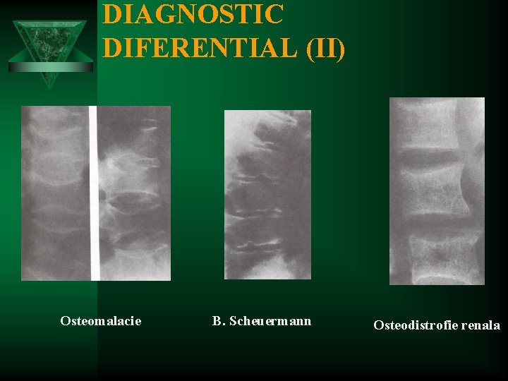 DIAGNOSTIC DIFERENTIAL (II) Osteomalacie B. Scheuermann Osteodistrofie renala 