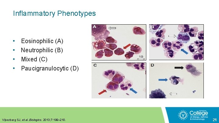 Inflammatory Phenotypes • • Eosinophilic (A) Neutrophilic (B) Mixed (C) Paucigranulocytic (D) Vijverberg SJ,