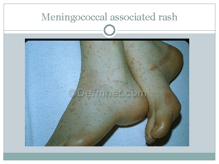 Meningococcal associated rash 