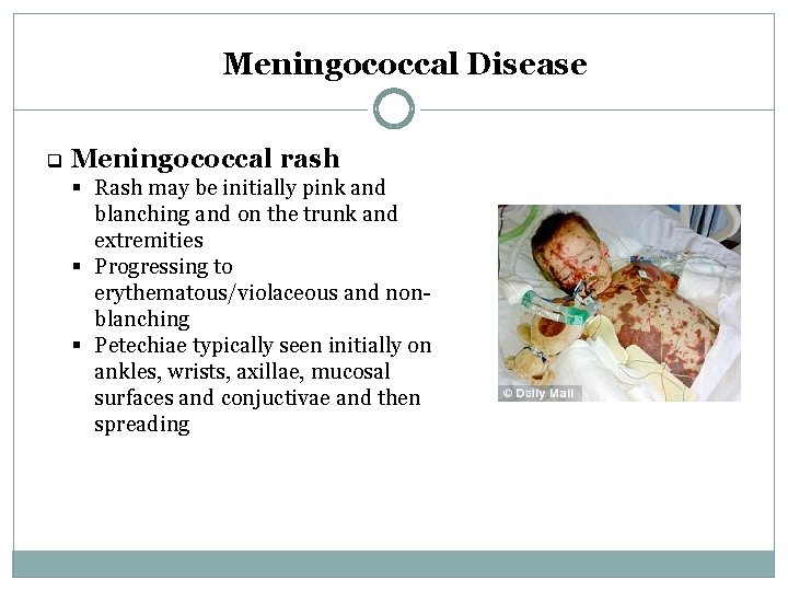 Meningococcal Disease q Meningococcal rash § Rash may be initially pink and blanching and