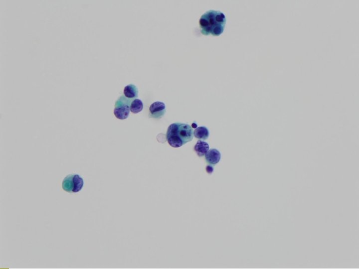 Cytologic Findings Cellularity moderate p Individually scattered or