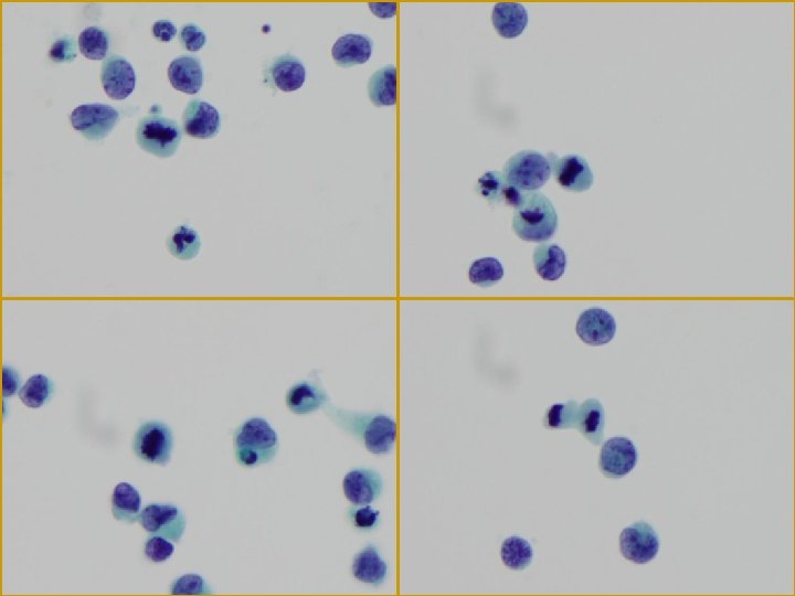 Cytologic Findings Cellularity moderate p Individually scattered or