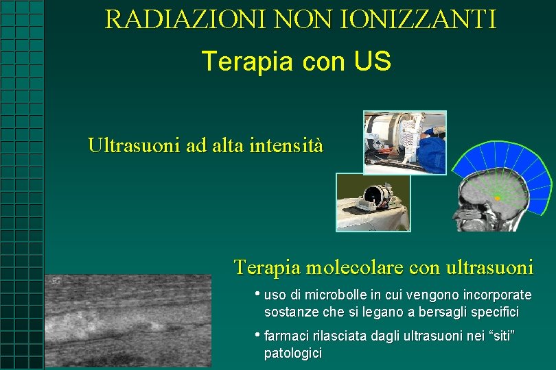 RADIAZIONI NON IONIZZANTI Terapia con US Ultrasuoni ad alta intensità Terapia molecolare con ultrasuoni