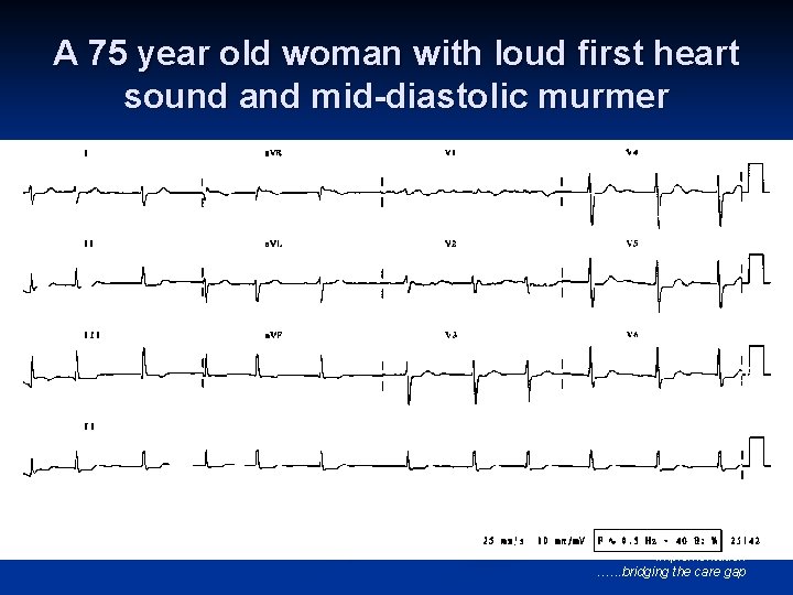 A 75 year old woman with loud first heart sound and mid-diastolic murmer ©