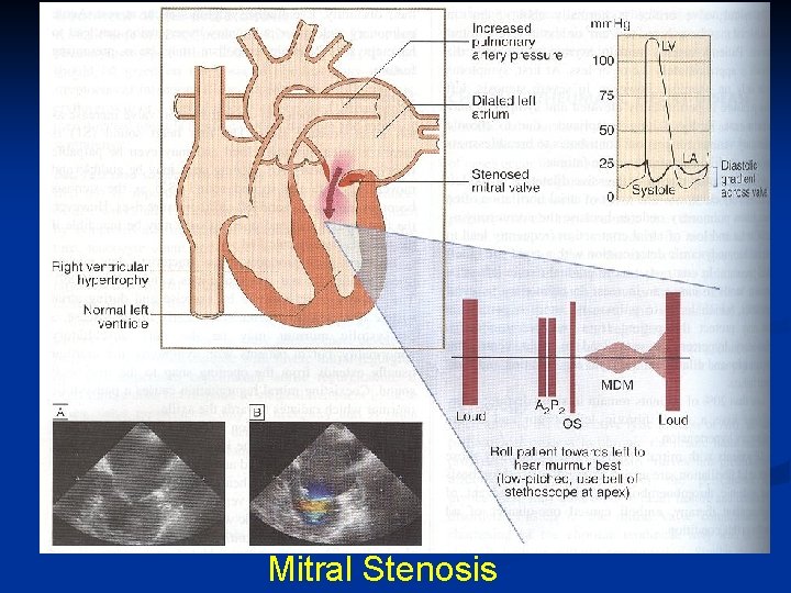 Mitral Stenosis 