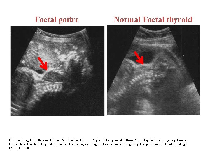 Foetal goitre Normal Foetal thyroid Peter Laurberg, Claire Bournaud, Jesper Karmisholt and Jacques Orgiazzi.