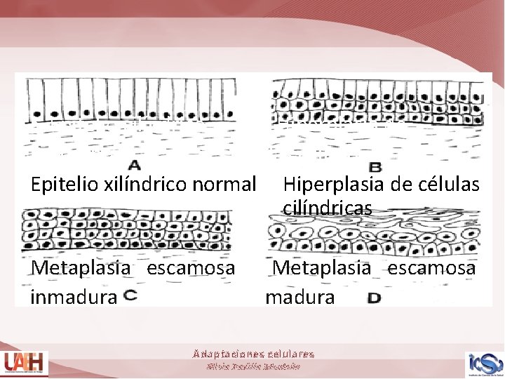  • Epitelio cilíndrico Hiperplasia de • normal células cilíndricas Epitelio xilíndrico normal Hiperplasia