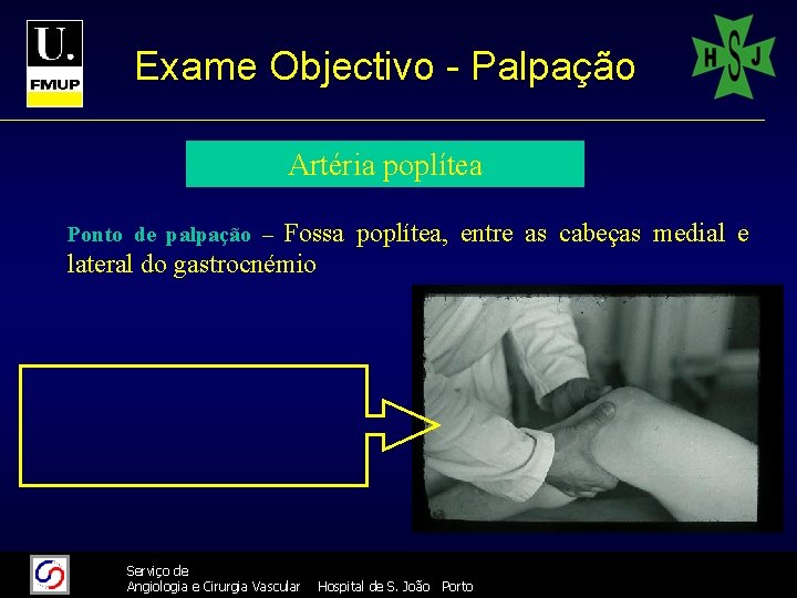 Exame Objectivo - Palpação Artéria poplítea Fossa poplítea, entre as cabeças medial e lateral