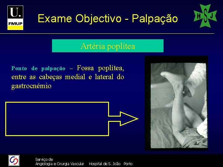 Exame Objectivo - Palpação Artéria poplítea Fossa poplítea, entre as cabeças medial e lateral