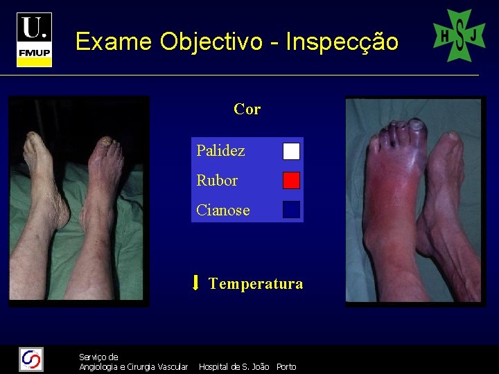 Exame Objectivo - Inspecção Cor Palidez Rubor Cianose Temperatura 11/26/2020 26/11/2020 Serviço de Angiologia