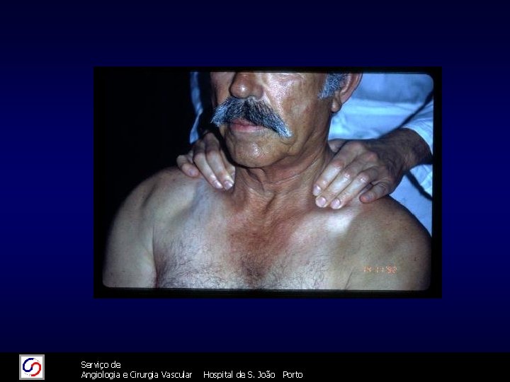 11/26/2020 26/11/2020 Serviço de Angiologia e Cirurgia Vascular 66 Hospital de S. João Porto