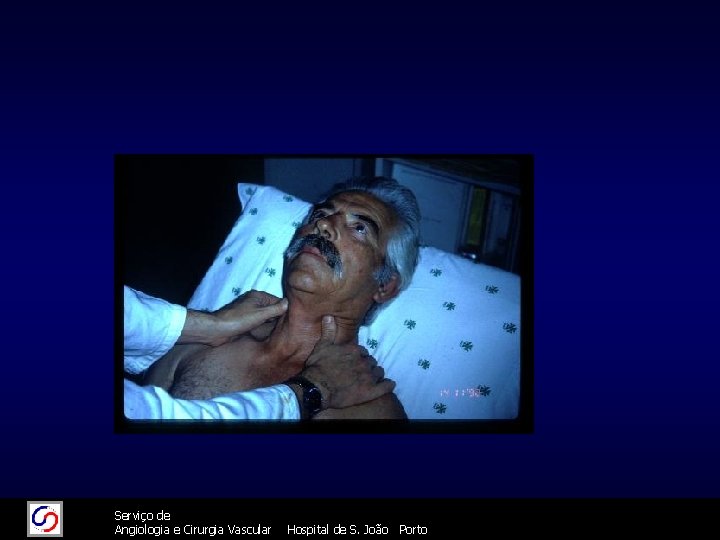 11/26/2020 26/11/2020 Serviço de Angiologia e Cirurgia Vascular 74 Hospital de S. João Porto