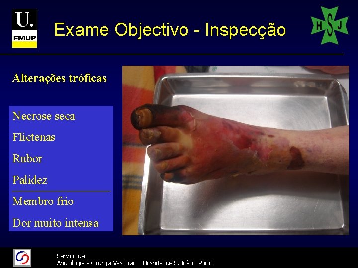 Exame Objectivo - Inspecção Alterações tróficas Necrose seca Flictenas Rubor Palidez Membro frio Dor