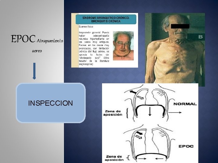 EPOC Atrapamiento aereo INSPECCION 