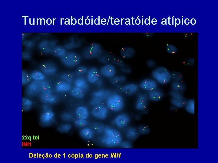 Tumor rabdóide/teratóide atípico 22 q tel INI 1 Deleção de 1 cópia do gene