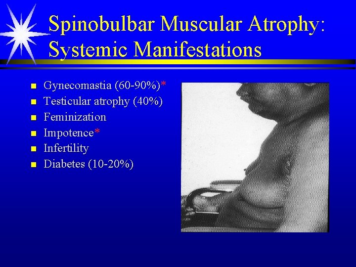 Spinobulbar Muscular Atrophy: Systemic Manifestations n n n Gynecomastia (60 -90%)* Testicular atrophy (40%) Spinobulbar Muscular Atrophy: Systemic Manifestations n n n Gynecomastia (60 -90%)* Testicular atrophy (40%)
