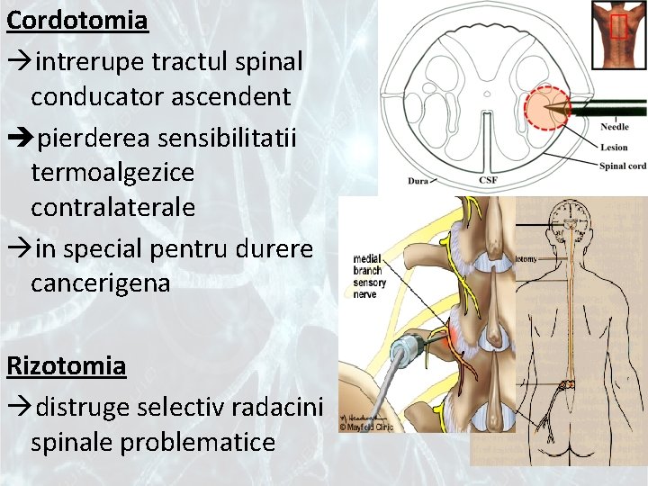 Cordotomia intrerupe tractul spinal conducator ascendent pierderea sensibilitatii termoalgezice contralaterale in special pentru durere