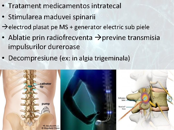  • Tratament medicamentos intratecal • Stimularea maduvei spinarii electrod plasat pe MS +