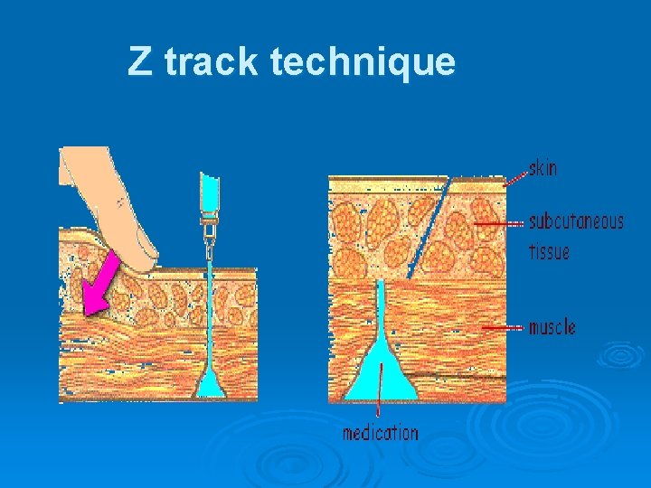 Z track technique 