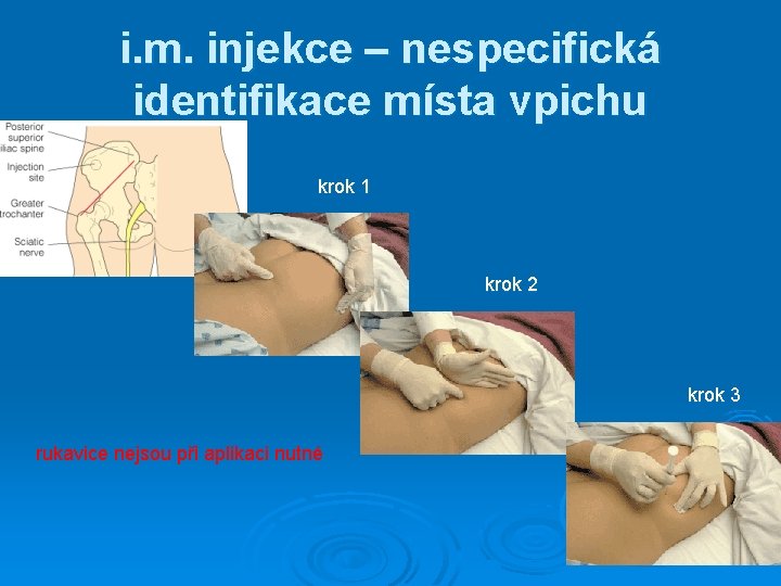 i. m. injekce – nespecifická identifikace místa vpichu krok 1 krok 2 krok 3